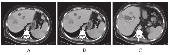 图3 腹部增强CT（第二次入院）.jpg